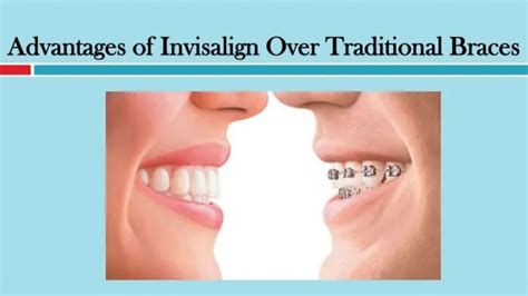 Ppt Advantages Of Invisalign Over Traditional Braces Dietary Freedom