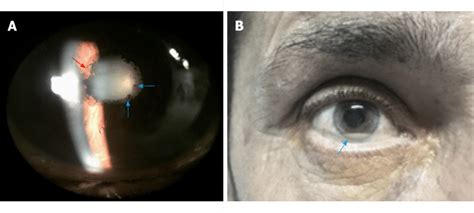 Anterior Uveitis Slit Lamp