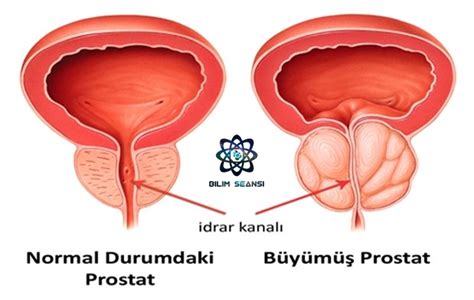 Prostat Kanseri Nedir