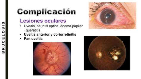 Brucelosis diagnóstico tratamiento diagnóstico PPT