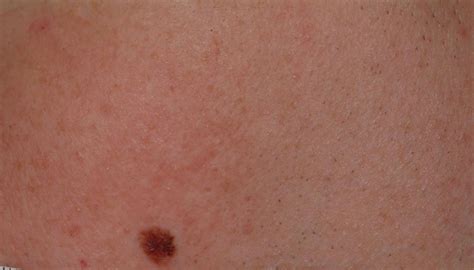 Red Spots On Your Skin