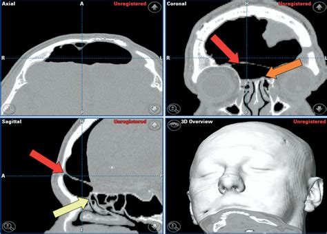 Endoscopic Frontal Outflow Tract Obliteration For Pneumocephalus After