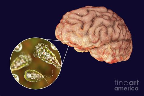 Brain Eating Amoeba Infection Photograph By Kateryna Kon Science Photo