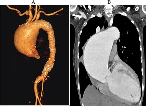 CT aortogram showing marked fusiform dilation involving sino tubular ...