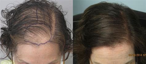 Womens Hair Transplant Before And After Pictures Dr Sean Behnam