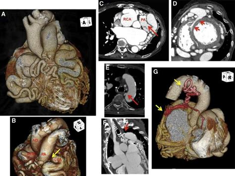 Volume Rendering Vr Images A B And Slice Views C Of Coronary