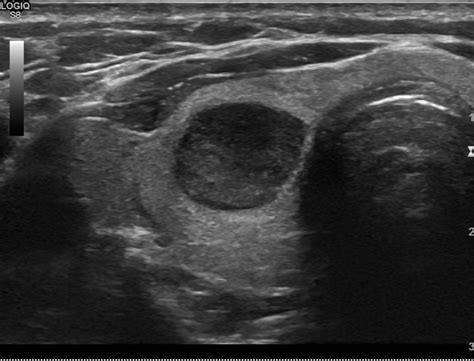 Classification Eu Tirads Toulouse Thyroide