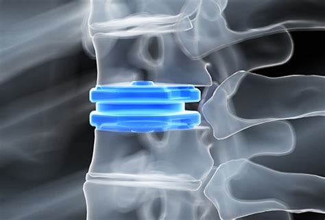 Disc Replacement | Interventional Spine & Surgery Group