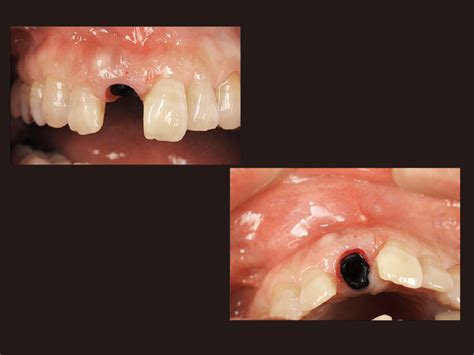 【モリタ】インプラント抜歯即時埋入による上顎前歯部審美修復治療｜デンタルマガジン｜歯科情報ポータルサイト デンタルプラザ