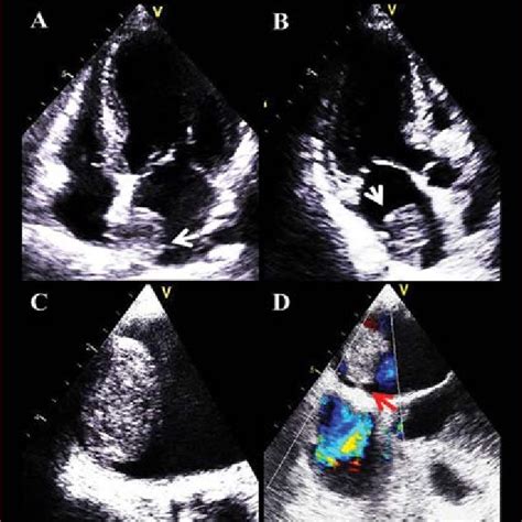 Cardiac Involvement A B Transthoracic Echocardiography Apical