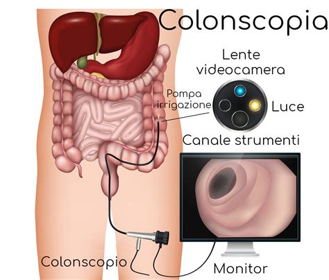 Colonscopia è dolorosa Come si svolge l esame