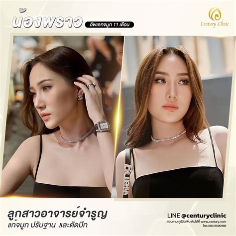 รีวิว แก้จมูก 616 Century Plus Clinic