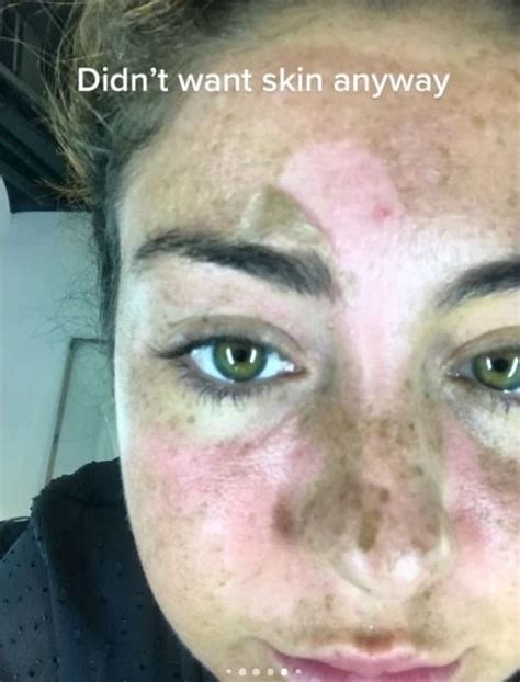 Woman Left Bed Bound By Sunbed But Trolls Say Its Totally Her Own