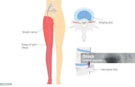 Diagram Shows The Sciatica Nerve From A Herniated Disc And Trapped ...