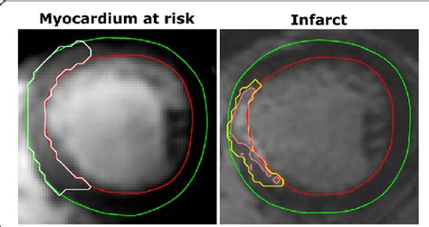 Example Cmr Images Illustrating The Measurement Of Myocardium At Risk