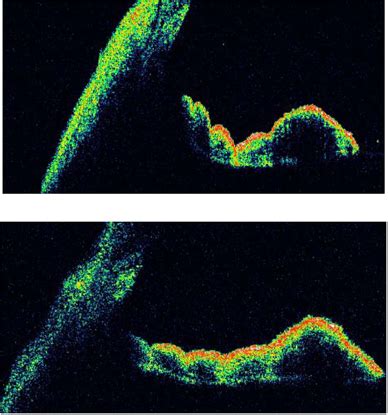 Oct Of The Angles Before Top And After Bottom Laser Iridoplasty