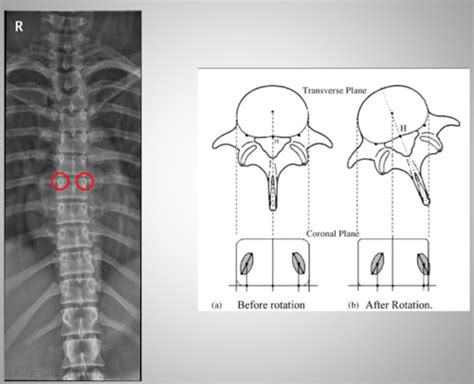 Clinical Imaging Thoracic Spine Flashcards Quizlet