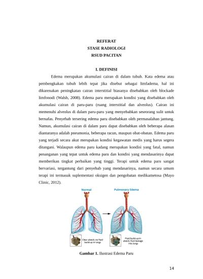 Edema Paru Pada Gagal Jantung