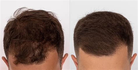 Minoxidil Before And After Photos [2022] Is It Right For You