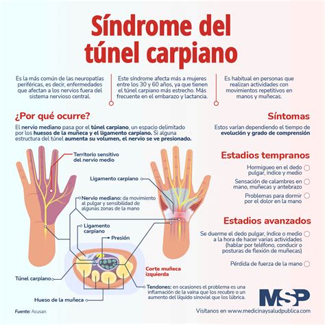 S Ndrome Del Tunel Carpiano Infograf A