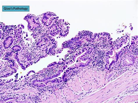 Qiaos Pathology Gallbladder Glandular Dysplasia High Grade A