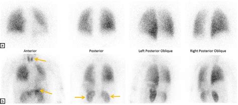 Planar Lung Scintigraphy Vq A Ventilation Phase With Normal