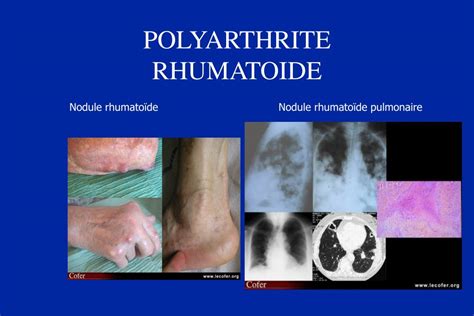 Ppt Polyarthrite Rhumato De Olivier Brocq Service Rhumatologie