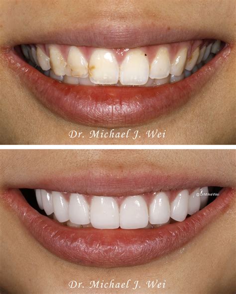 Composite Veneers Cost