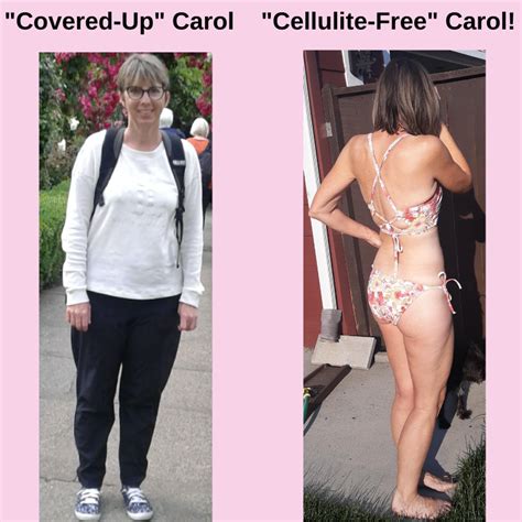 Carols Big Cellulite Success Story Before And After Her Cellulite Removal Joey Atlas