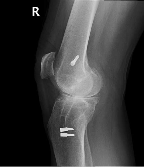 Total Knee Replacement Dr Mohamed Attia M D PhD