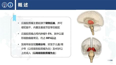 上海长海医院神经外科：丘脑巨大胶质瘤诊断及手术的精准理念 脑医汇 神外资讯 神介资讯