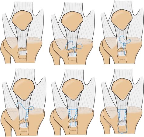 Schemefigure Depicting The Technique To Fix The Tibial Tubercle The Download Scientific