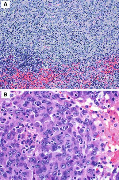 Follicular Dendritic Cell Sarcoma A Proliferation Of Spindled To