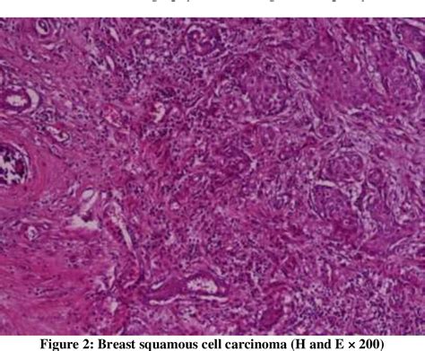 Figure 2 From Pure Squamous Cell Carcinoma Of The Breast In A Male