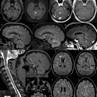 Serial T Mri Scans In Case Obtained Days After Symptom Onset