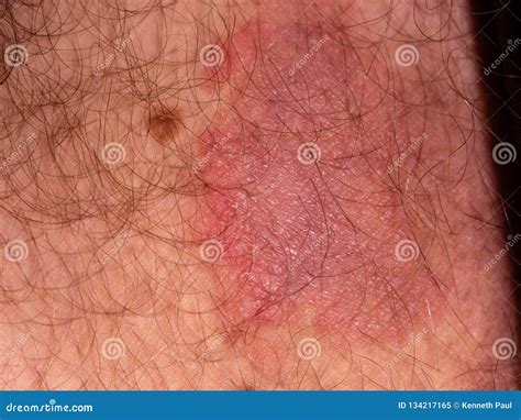 Fungal Infection On Skin Of Male Leg Stock Image Image Of Ringworm Dermatitis 134217165