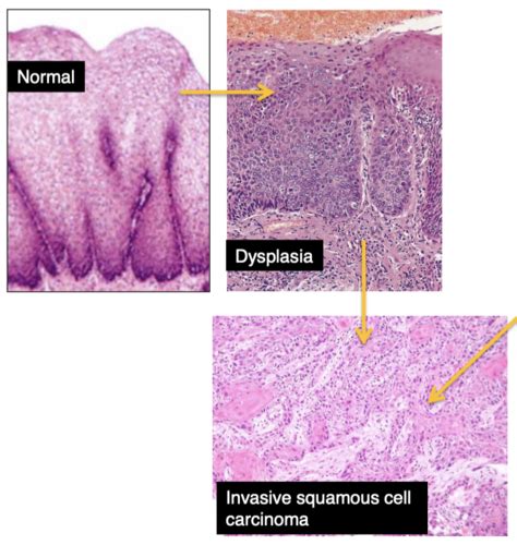 Pathology Of Gi Cancers Flashcards Quizlet