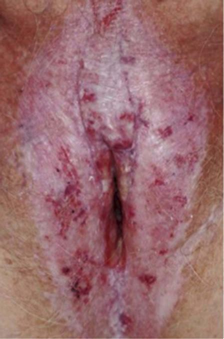 Erosive Lichen Planus Of The Vulva And Vagina Semantic 56 OFF