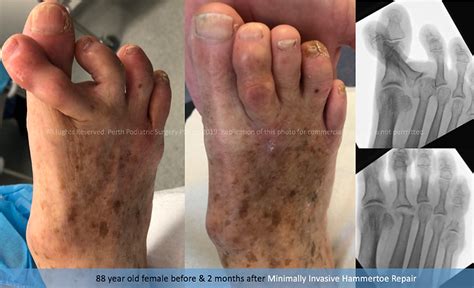 Mis Hammertoe Repair Keyhole Foot Surgery Australia