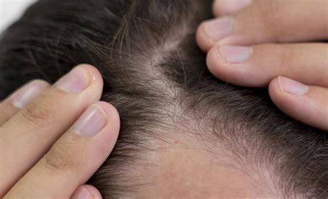 Caída del cabello cuándo preocuparse por caída del pelo