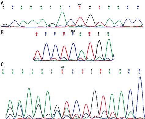 Electrophoregrams Of Exon 18 And Intron 17 Of OCRL After Sanger