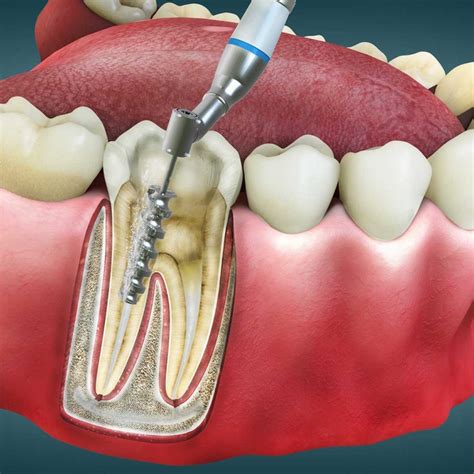 What Is Sinus Perforation Dentevim Dental Clinic