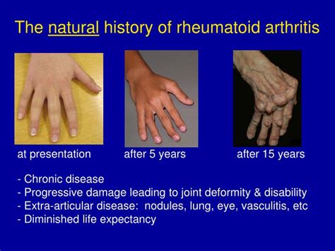 Ppt Rheumatoid Arthritis Powerpoint Presentation Id