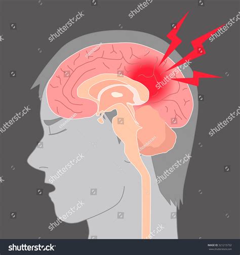 Headache Cerebral Hemorrhage Brain Stroke Royalty Free Stock