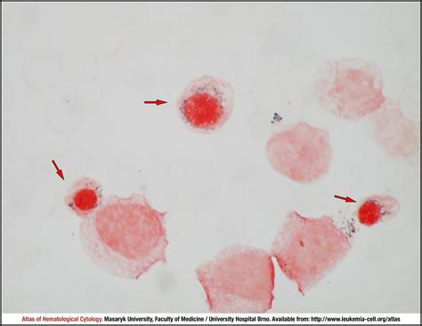 Myelodysplastic Syndrome With Ring Sideroblasts And With Multilineage