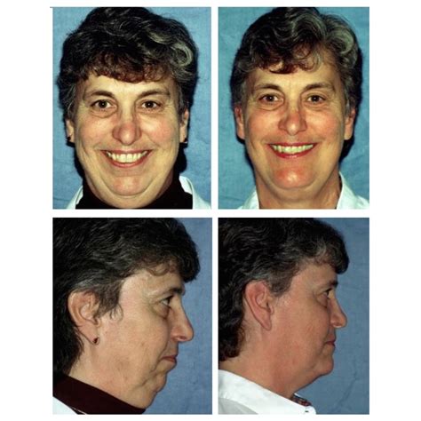 Before and After Photos Maxillofacial Surgery - Larry M. Wolford, DMD