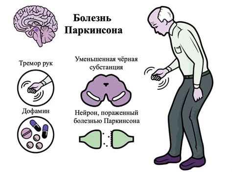Болезнь Паркинсона – Что Это Такое? (Причины, 5 Стадий Развития)