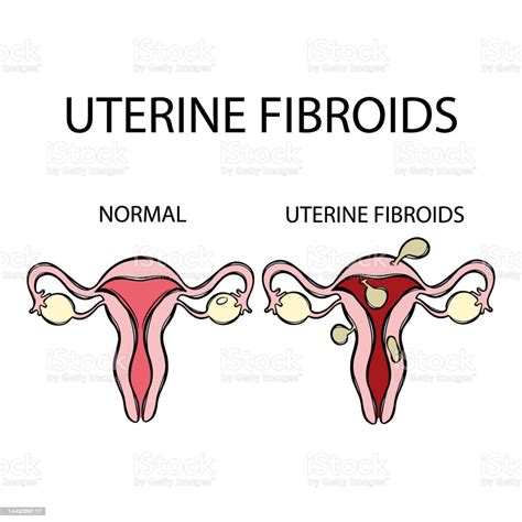 Uterine Fibroids Vs Normal Female Reproductive Education Set Stock