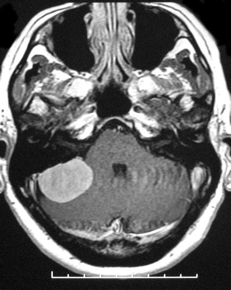 Cerebellopontine Angle Meningioma Image