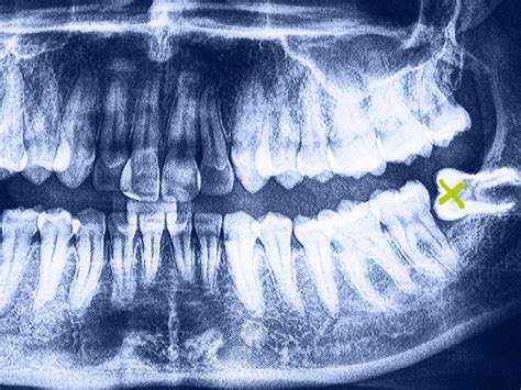 How To Take Care Of Wisdom Teeth Treatbeyond2